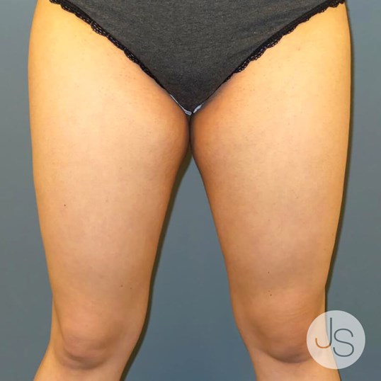 Thigh Lift Before and After Pictures Beverly Hills, CA