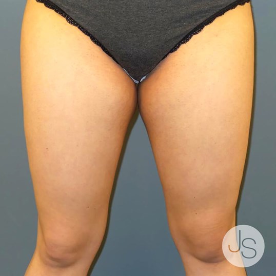 Thigh Lift Before and After Pictures Beverly Hills, CA