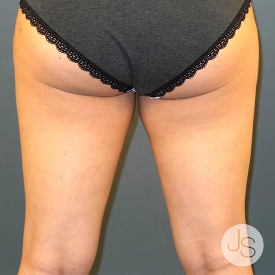 Thigh Lift Before and After Pictures Beverly Hills, CA