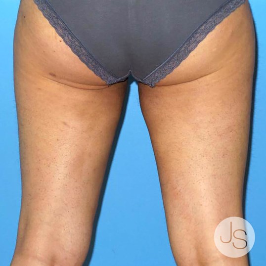 Thigh Lift Before and After Pictures Beverly Hills, CA