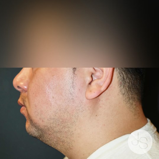 Neck Lift Before and After Pictures Beverly Hills, CA