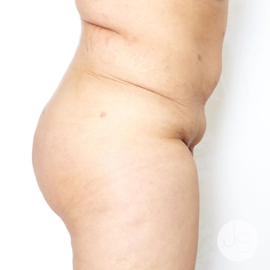 Fat Transfer Before and After Pictures Beverly Hills, CA