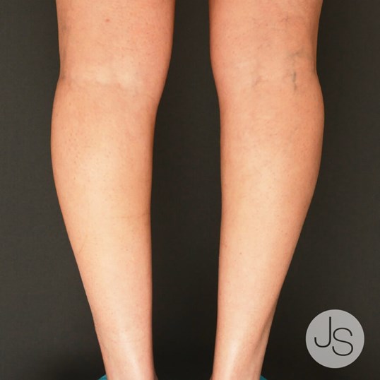 Calf Augmentation Before and After Pictures Beverly Hills, CA