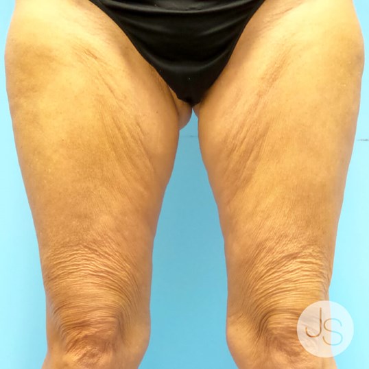 Thigh Lift Before and After Pictures Beverly Hills, CA