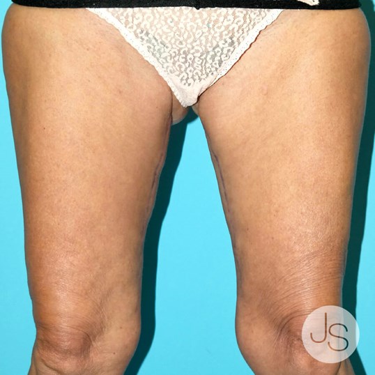 Thigh Lift Before and After Pictures Beverly Hills, CA