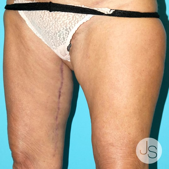 Thigh Lift Before and After Pictures Beverly Hills, CA