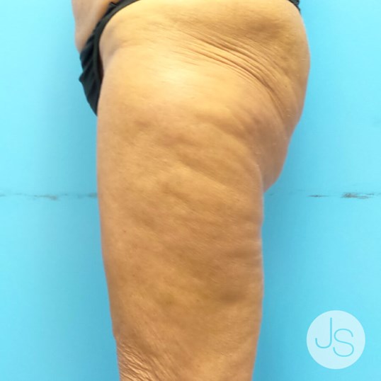 Thigh Lift Before and After Pictures Beverly Hills, CA