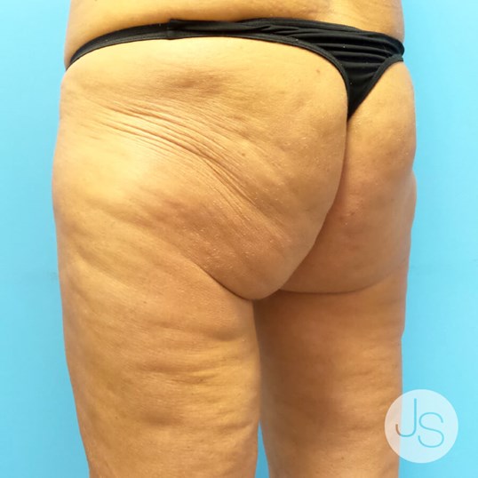 Thigh Lift Before and After Pictures Beverly Hills, CA