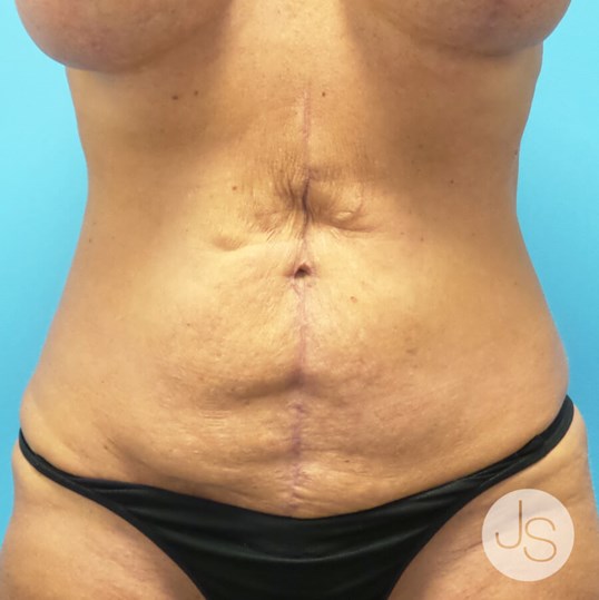 Scars and Treatments Before and After Pictures Beverly Hills, CA
