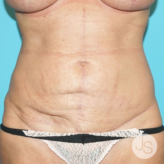 Scars and Treatments Before and After Pictures Beverly Hills, CA