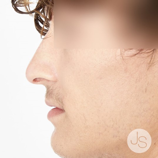 Rhinoplasty Before and After Pictures Beverly Hills, CA