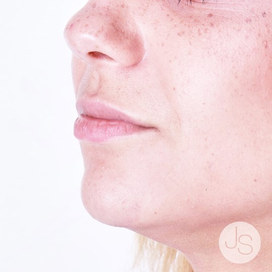 Juvederm Before and After Pictures Beverly Hills, CA