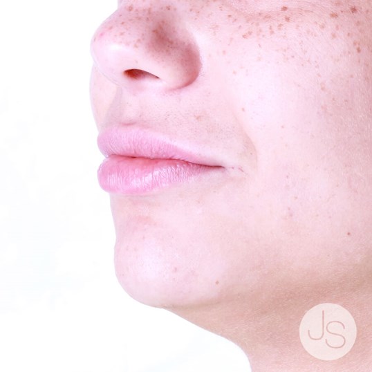 Juvederm Before and After Pictures Beverly Hills, CA