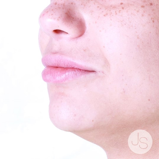 Lip Augmentation Before and After Pictures Beverly Hills, CA