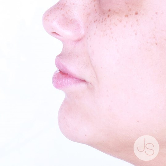 Juvederm Before and After Pictures Beverly Hills, CA