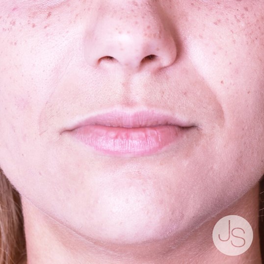 Juvederm Before and After Pictures Beverly Hills, CA