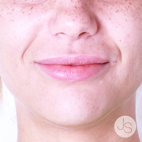 Juvederm Before and After Pictures Beverly Hills, CA