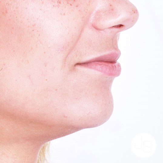 Juvederm Before and After Pictures Beverly Hills, CA