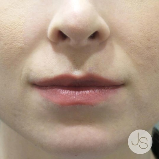 Lip Augmentation Before and After Pictures Beverly Hills, CA