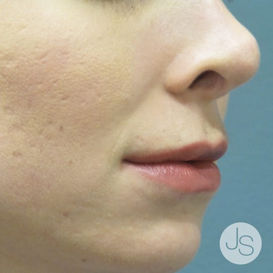 Lip Augmentation Before and After Pictures Beverly Hills, CA