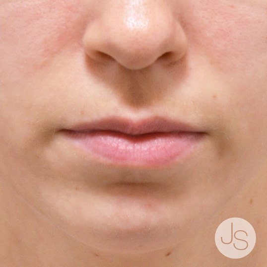 Juvederm Before and After Pictures Beverly Hills, CA