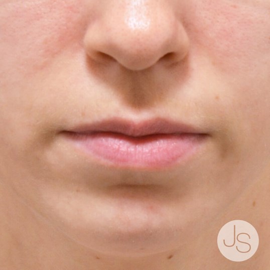 Lip Augmentation Before and After Pictures Beverly Hills, CA