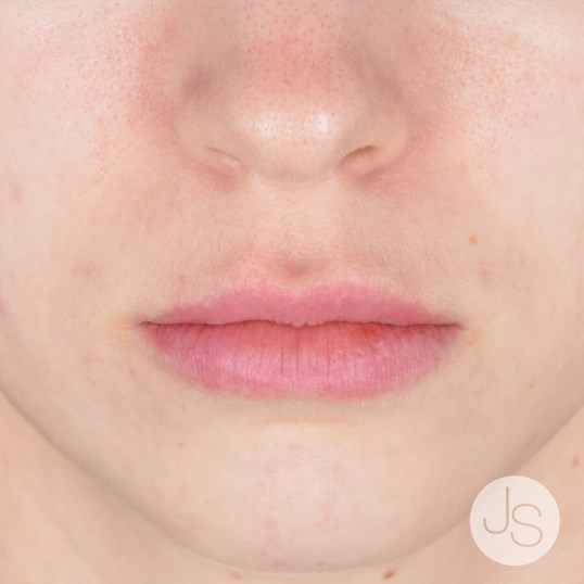 Juvederm Before and After Pictures Beverly Hills, CA