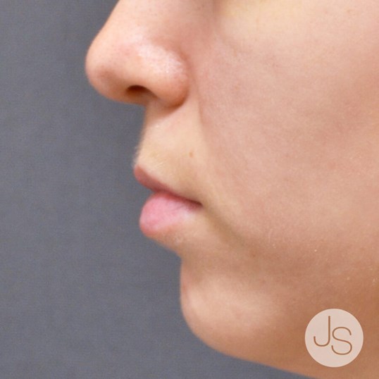 Juvederm Before and After Pictures Beverly Hills, CA