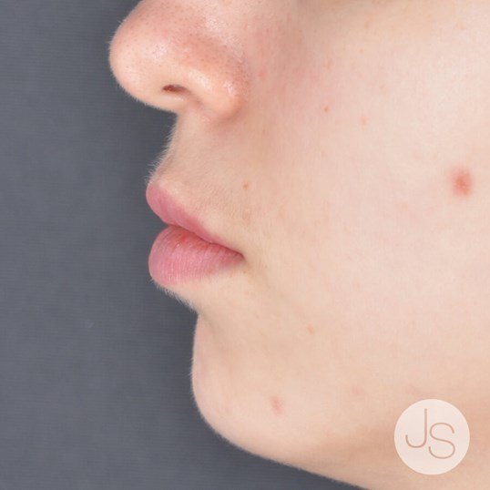 Juvederm Before and After Pictures Beverly Hills, CA