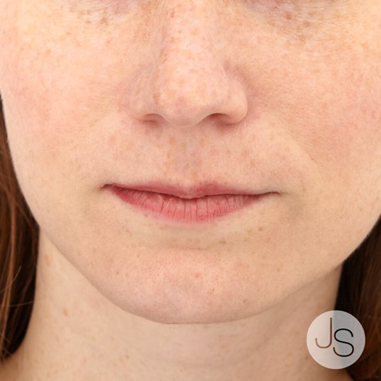 Juvederm Before and After Pictures Beverly Hills, CA