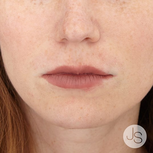 Juvederm Before and After Pictures Beverly Hills, CA