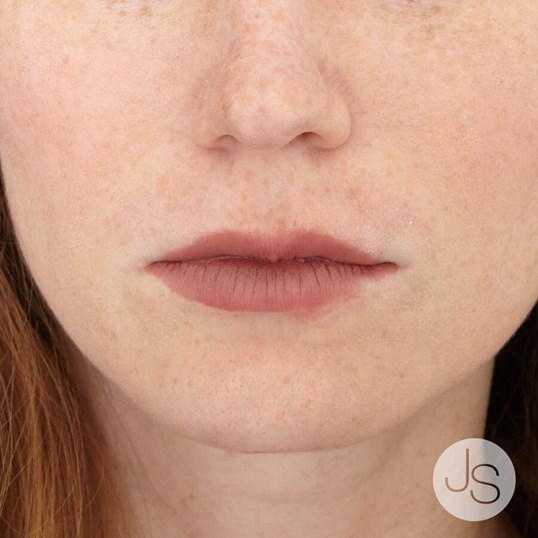 Lip Augmentation Before and After Pictures Beverly Hills, CA