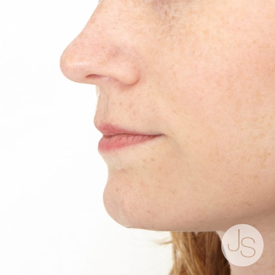 Juvederm Before and After Pictures Beverly Hills, CA