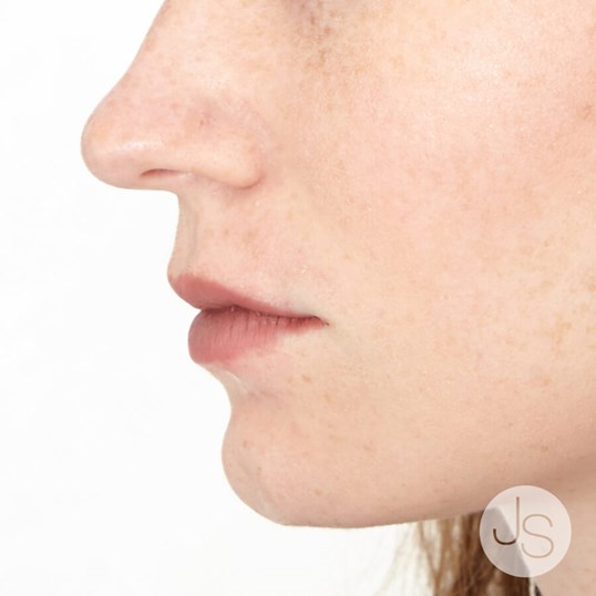 Juvederm Before and After Pictures Beverly Hills, CA