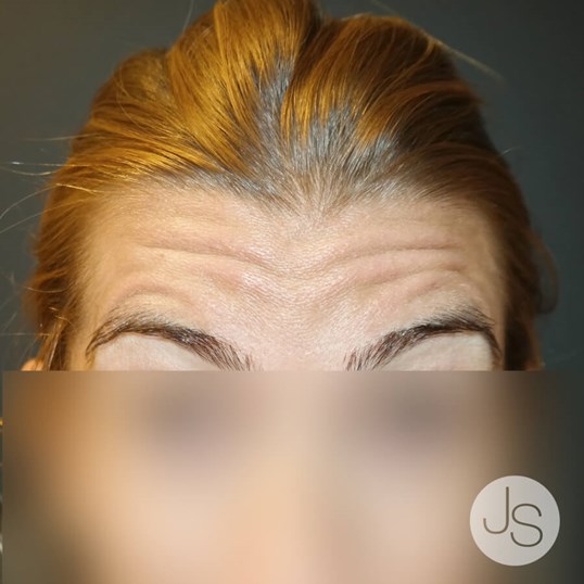 Botox Before and After Pictures Beverly Hills, CA