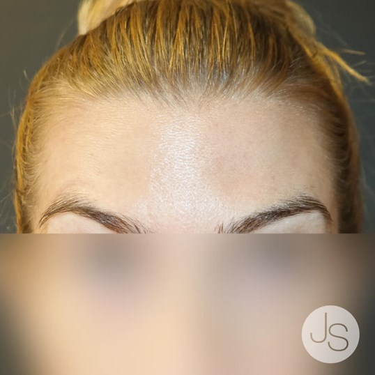 Botox Before and After Pictures Beverly Hills, CA