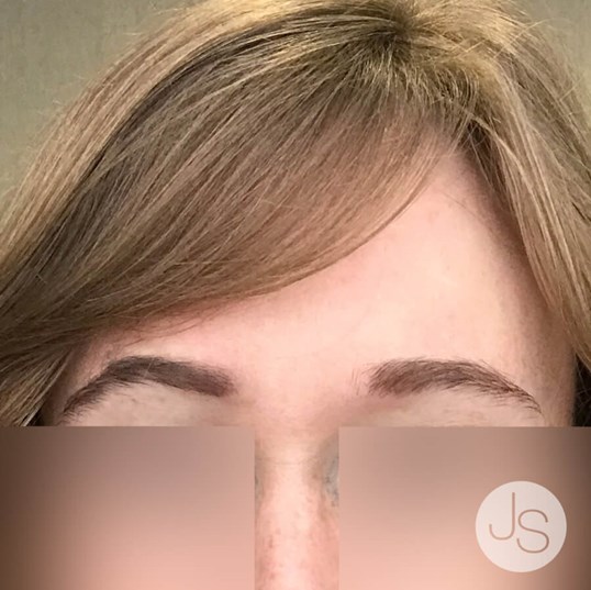 Botox Before and After Pictures Beverly Hills, CA