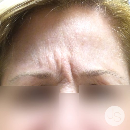 Botox Before and After Pictures Beverly Hills, CA