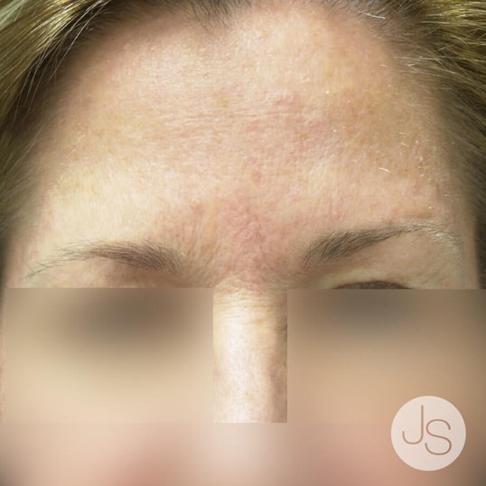 Botox Before and After Pictures Beverly Hills, CA