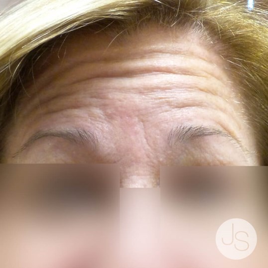 Botox Before and After Pictures Beverly Hills, CA