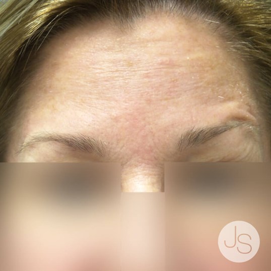 Botox Before and After Pictures Beverly Hills, CA