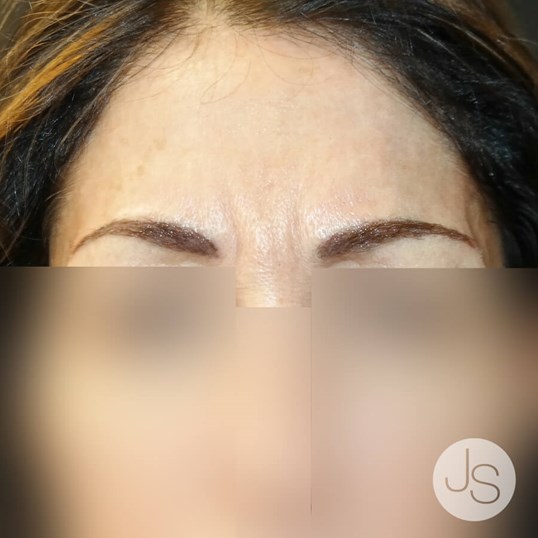 Botox Before and After Pictures Beverly Hills, CA