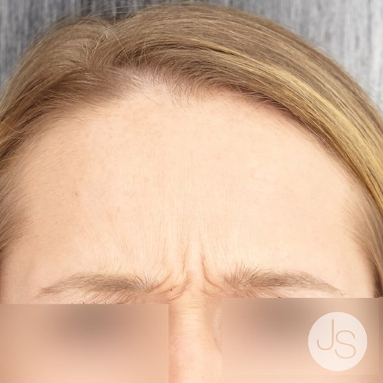 Botox Before and After Pictures Beverly Hills, CA