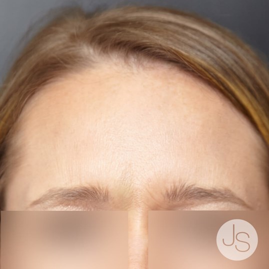 Botox Before and After Pictures Beverly Hills, CA