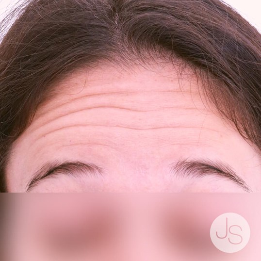 Botox Before and After Pictures Beverly Hills, CA