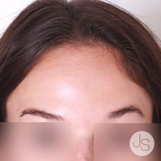 Botox Before and After Pictures Beverly Hills, CA