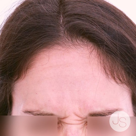 Botox Before and After Pictures Beverly Hills, CA