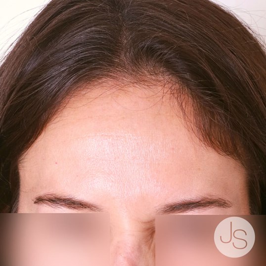 Botox Before and After Pictures Beverly Hills, CA