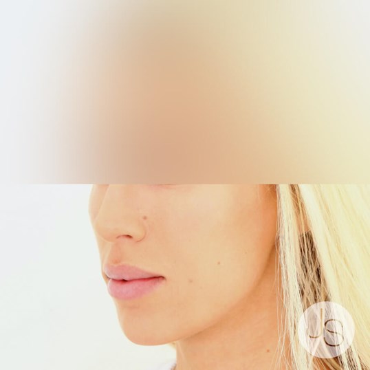 Juvederm Before and After Pictures Beverly Hills, CA