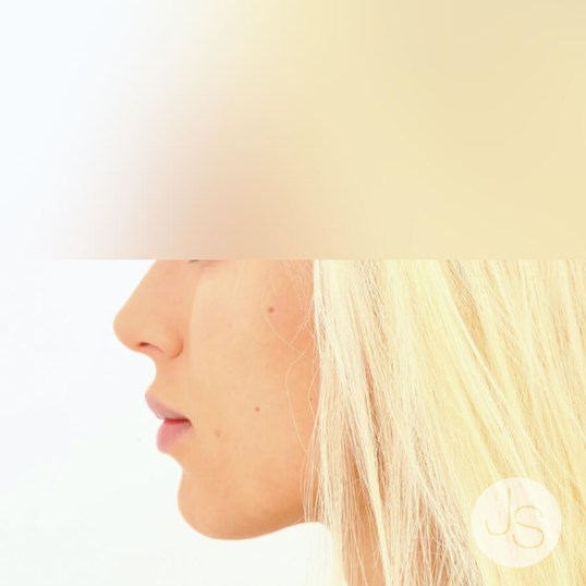 Juvederm Before and After Pictures Beverly Hills, CA